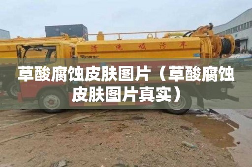 草酸腐蚀皮肤图片（草酸腐蚀皮肤图片真实）